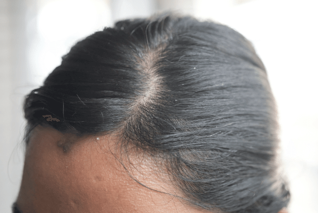 ראש של אישה עם שיער ופצעים